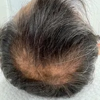 میکرواسکالپ کف سر