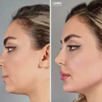 ژل بوتاکس آنزیم خال برداری فیلربینی فول فیس بلفارو