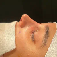 جراحی بینی با قیمت پارسال ( ظرفیت محدود )