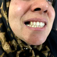 دندان مصنوعی + لابراتوار دندانسازی|خدمات آرایشگری و زیبایی|تهران, شهرک ولیعصر جنوبی|دیوار