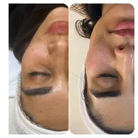 ژل وبوتاکس ولیزر وفشیال وخالبرداری ومزونیدلینگ|خدمات آرایشگری و زیبایی|تبریز, |دیوار
