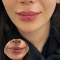 بوتاکس مصپورت۵۹۹ژل مجوزدار ۱/۲۰۰مادلینگ۵/۹۹۹|خدمات آرایشگری و زیبایی|قم, حاج زینل|دیوار