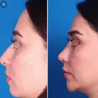 عمل جراحی بینی لیفت خدمات زیبایی با متد پیشرفته|خدمات آرایشگری و زیبایی|کرج, گلشهر|دیوار