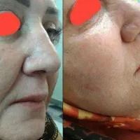 چین وچروک صورت. وبدون بازگشت.|آرایشی، بهداشتی، درمانی|تهران, شوش (باغ آذری)|دیوار