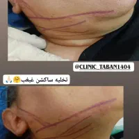 ساکشن وجراحی غبغب