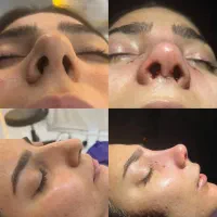 عمل زیبایی بینی با بهترین متد|خدمات آرایشگری و زیبایی|کرج, اتحاد|دیوار