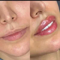 ژل و بوتاکس در منزل شما