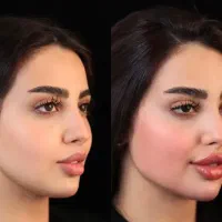 فیلرلب،ژل،چونه،پی ارپی،جوانساز|خدمات زیبایی و سلامت|کرج, جهانشهر|دیوار
