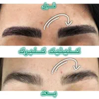 ریموو تتو صورت و بدن(گلبرگ)