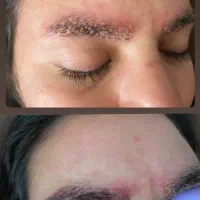حذف تتو وکربنپیلینگ نواحی تیره بدن