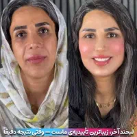 مرکز تخصصی جوانسازی اندولیفت/هایفو/لیفت فقط۸۹۰ت|خدمات آرایشگری و زیبایی|اصفهان, لاله|دیوار