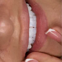 کامپوزیت vip دندان لیرینگ لبه شیشه ای