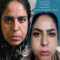 بوتاکس/ساکشن غبغب شکم/هایفو/فیلر/prp