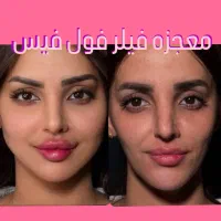 بوتاکس پیشانی،خط اخم  رایگان شد توسط پزشک|خدمات آرایشگری و زیبایی|کاشان, بهشتی|دیوار