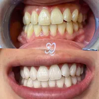 سفید کردن دندان (بلیچینگ)|خدمات آرایشگری و زیبایی|فولادشهر, B2|دیوار