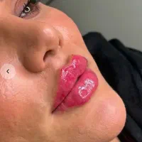 تخفیف ویژه فیلر و بوتاکس