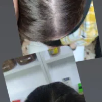 رشد مجدد رفع ریزش بعد کاشت و مشکلات سکه ای و