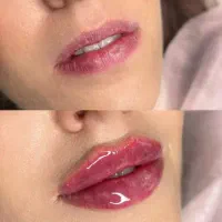 تزریق ژل و بوتا کس