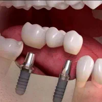 خدمات ایمپلنت دیجیتال|خدمات آرایشگری و زیبایی|شیراز, معالی‌آباد|دیوار