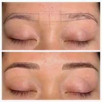 میکروبلیدینگ، فیبروز، بن مژه