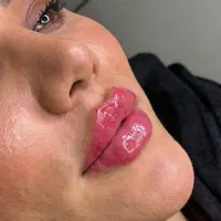 تزریق ژل و بوتاکس لیفت نخ جدیدترین متد مطب زیبایی