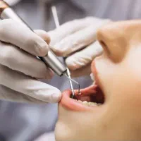 عصب کشی دندان با تعرفه دولتی