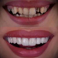جشنواره پاییزه کامپوزیت لمینیت روکش طلا عصب کشی|خدمات آرایشگری و زیبایی|تهران, هفت حوض|دیوار