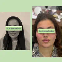 تخصصی ترین جوانسازی پی ار پیprp با ضمانت توسط پزشک