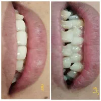 تخفیفات ویژه کامپوزیت در درمانگاه تخصصی یاسوج|خدمات آرایشگری و زیبایی|یاسوج, |دیوار