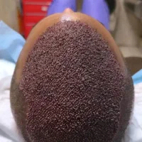 کاشت مو و ابرو تخصصی مزوتراپی و پی ار پی