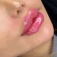 آموزش تزریق ژل بدون سوزن ،بدون هزینه خودت ژل بزن