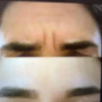 بوتاکس
