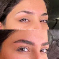 فیبروز و میکروبلیدینگ کرکی سوپر نچرال با تخفیف70%|خدمات زیبایی و سلامت|تبریز, |دیوار
