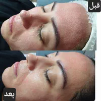 پاکسازی و فیشال تخصصی و درمانی با بهترین برندها|خدمات آرایشگری و زیبایی|پرند, فاز ۲|دیوار