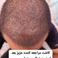 کاشت مو در بانه فقط ده میلیون