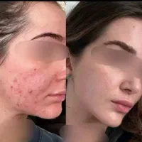 کرم انتی آکنه و جای جوش و اسکار