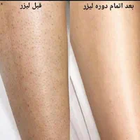 لیزر موهای زائدالکساندرایت‌کندلاآمریکایی‌اصل|خدمات آرایشگری و زیبایی|اندیشه, اندیشه فاز ۱|دیوار