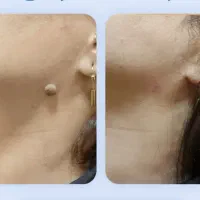 خال برداری صورت و بدن