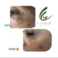 تخفیف ویژه یلدا و روز مادر فیشال تخصصی پوست|خدمات آرایشگری و زیبایی|مشهد, هفت تیر (آب و برق)|دیوار