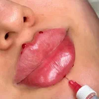 ساکشن چربی و تزریق ژل و بوتاکس و مزو لیفت شقیقه و.|خدمات آرایشگری و زیبایی|کرمانشاه, |دیوار
