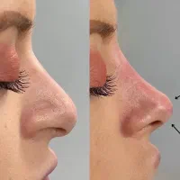 مدل تزریق ژل،فیلر،بوتاکس،لیفت بانخ،جوانساز|خدمات آرایشگری و زیبایی|کرج, مهرویلا شمالی|دیوار