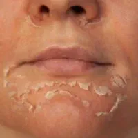 پاکسازی و لایه برداری