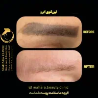 آف لیزر حذف تتو/لک پوست/پیلینگ کربن/روشنسازیDrمقدم|خدمات آرایشگری و زیبایی|مشهد, هفت تیر (آب و برق)|دیوار