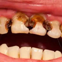 تخفیف ویژه عصب کشی و جرم گیری زیر نرخ دولتی
