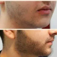 خداحافظی با کم‌پشتی ریش و سبیل