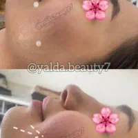 تزریق ژل و بوتاکس|خدمات آرایشگری و زیبایی|بابل, |دیوار