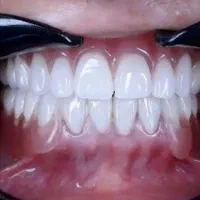 ساخت دندان مصنوعی از دم چک