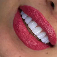 کامپوزیت دندان لیزرمو ژل بوتاکس فیلر مزو پی ارپی