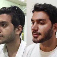 ژل بوتاکس فیلربادی