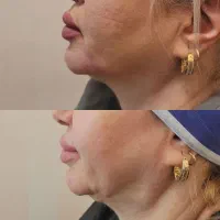 اسپارتینا زیکورپا لاغری بوتاکس فیلر مزوژل نخ لیفت|خدمات زیبایی و سلامت|تهران, هاشمی|دیوار